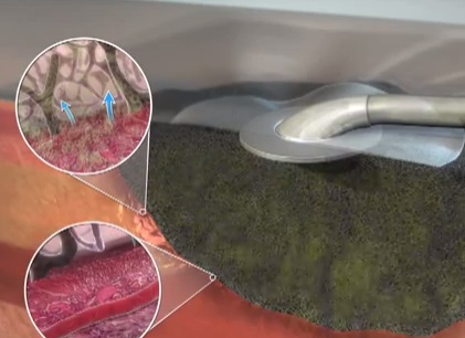 The V.A.C. ATS Therapy System from KCI